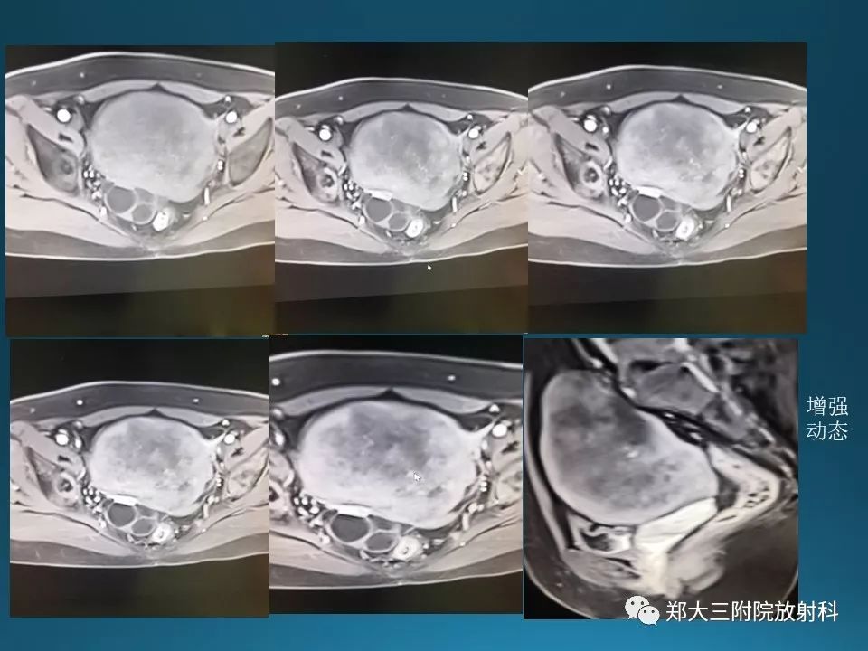 【PPT】卵泡膜纤维瘤的诊断及鉴别诊断