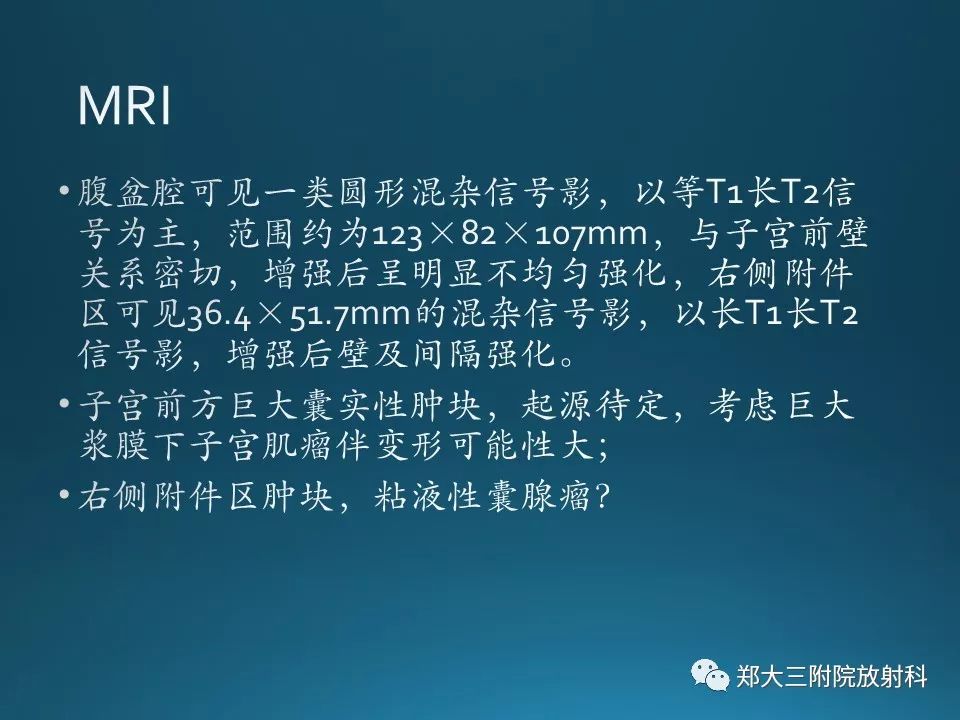 【PPT】卵泡膜纤维瘤的诊断及鉴别诊断