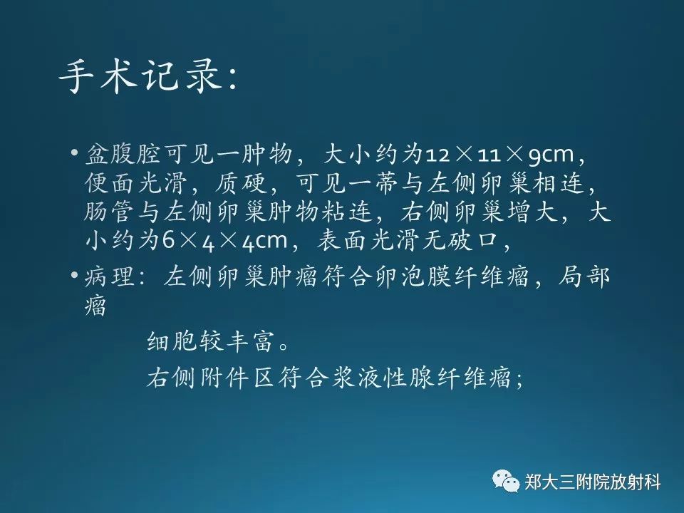 【PPT】卵泡膜纤维瘤的诊断及鉴别诊断