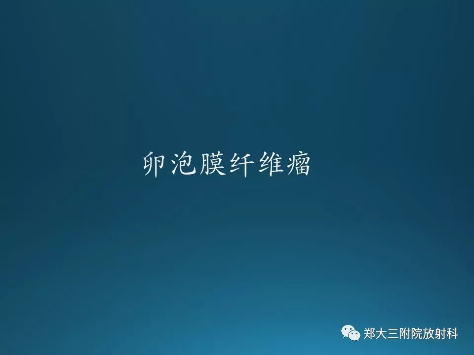 【PPT】卵泡膜纤维瘤的诊断及鉴别诊断