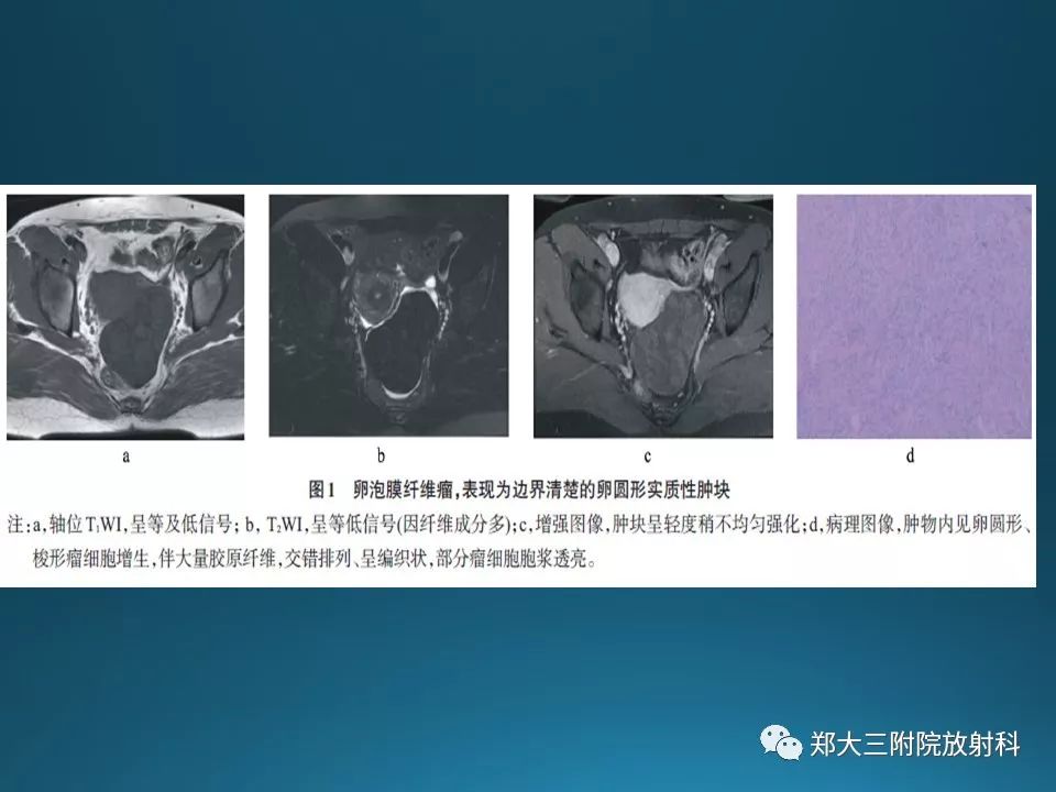 【PPT】卵泡膜纤维瘤的诊断及鉴别诊断