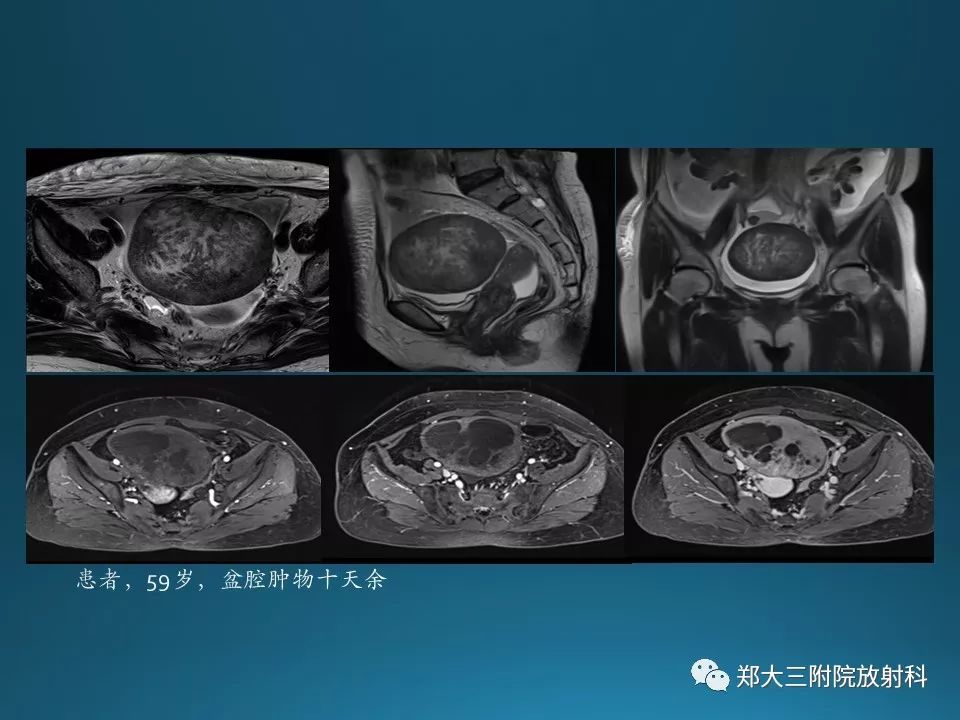 【PPT】卵泡膜纤维瘤的诊断及鉴别诊断