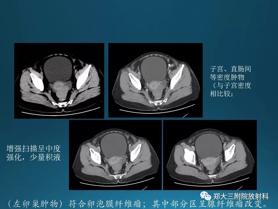 【PPT】卵泡膜纤维瘤的诊断及鉴别诊断