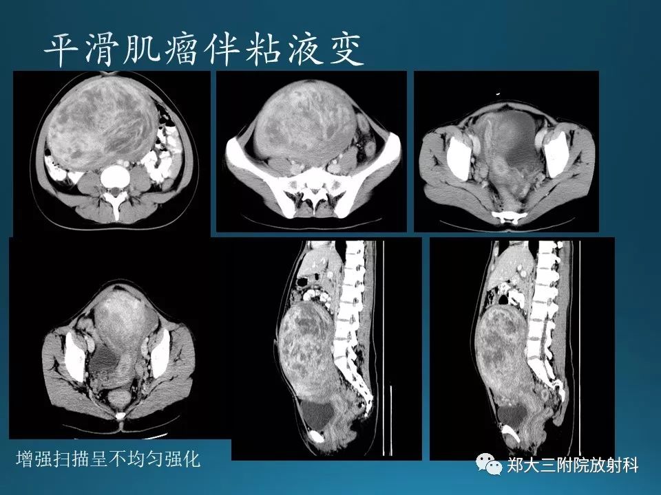【PPT】卵泡膜纤维瘤的诊断及鉴别诊断
