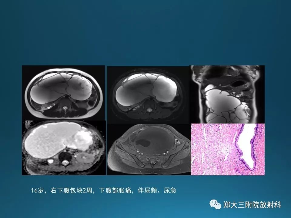 【PPT】卵泡膜纤维瘤的诊断及鉴别诊断