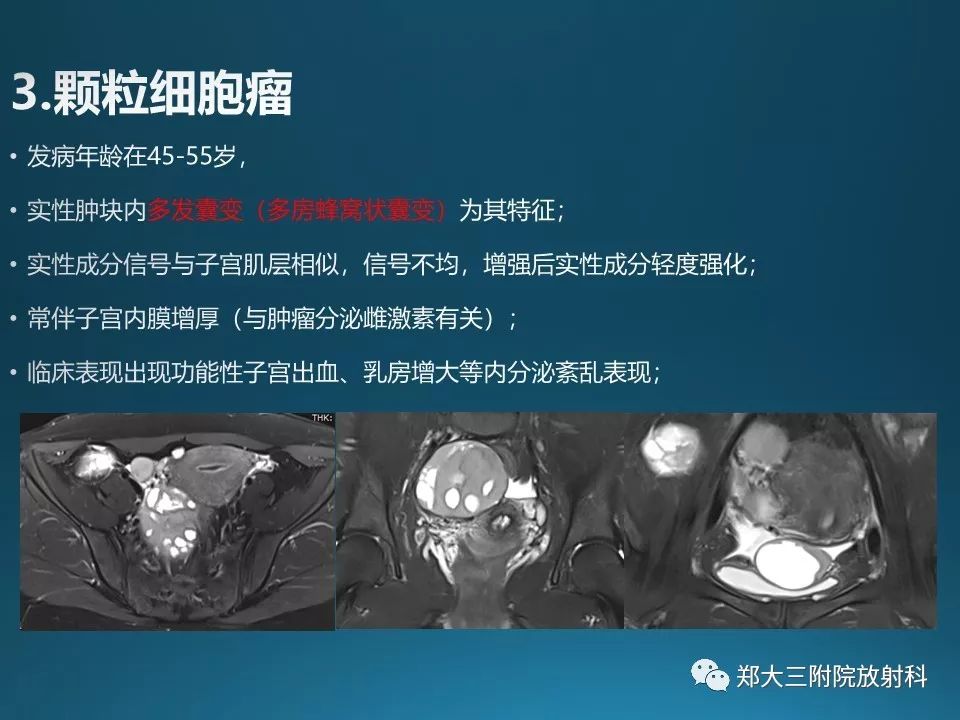 【PPT】卵泡膜纤维瘤的诊断及鉴别诊断