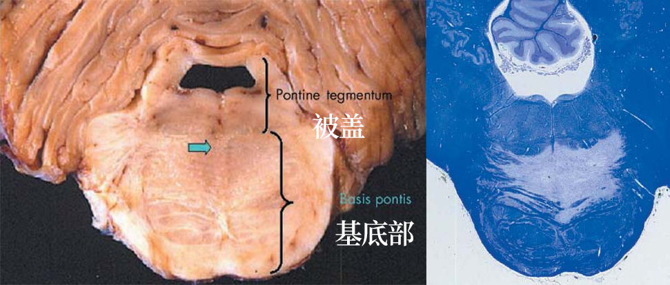 渗透性髓鞘溶解及其影像解析 渗透性髓鞘溶解及其影像解析