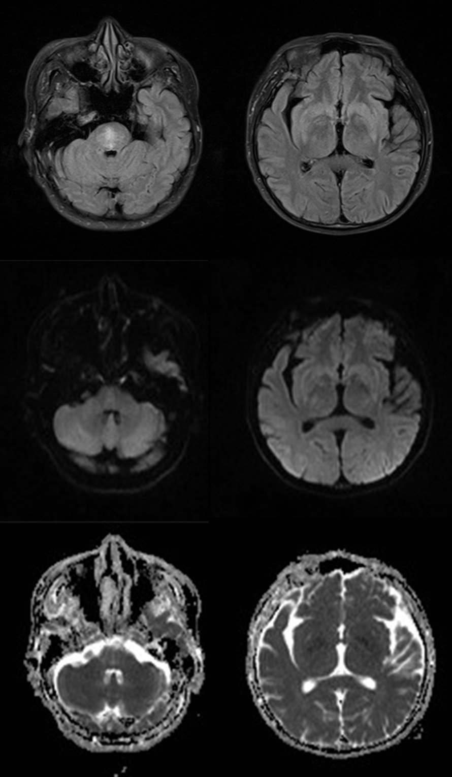 渗透性髓鞘溶解及其影像解析 渗透性髓鞘溶解及其影像解析