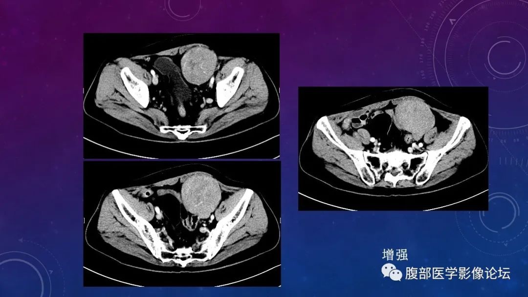 【病例】盆腔精原细胞瘤1例CT影像讨论 【病例】盆腔精原细胞瘤1例CT影像讨论