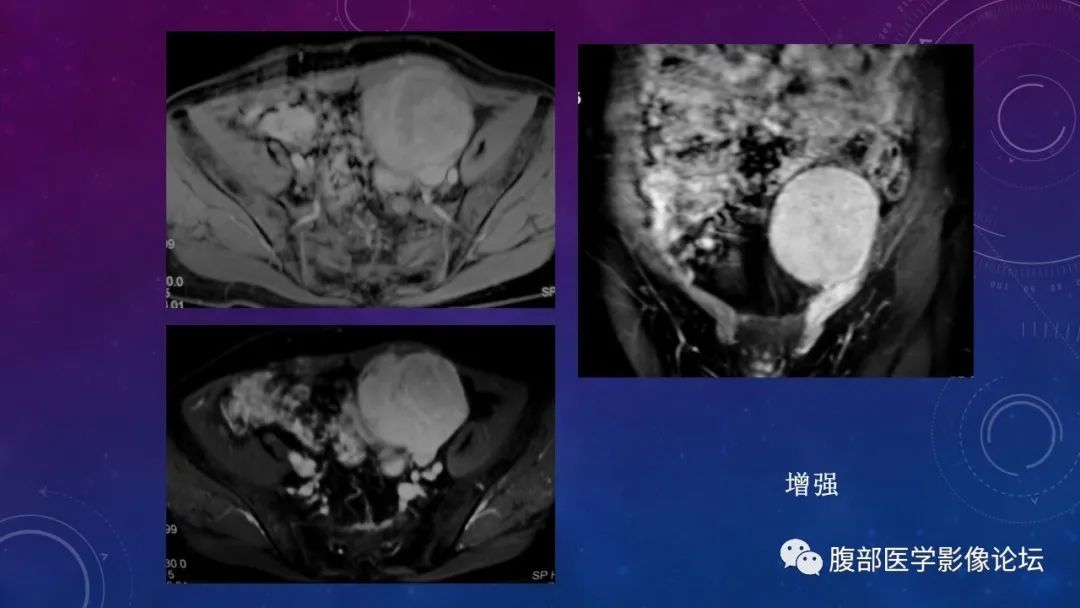 【病例】盆腔精原细胞瘤1例CT影像讨论 【病例】盆腔精原细胞瘤1例CT影像讨论