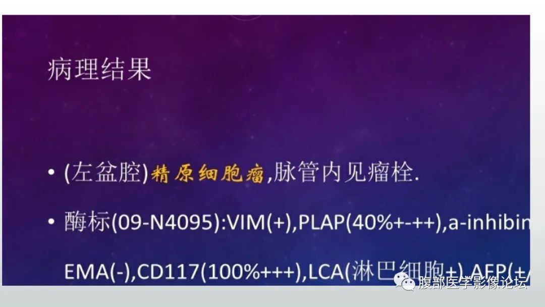 【病例】盆腔精原细胞瘤1例CT影像讨论 【病例】盆腔精原细胞瘤1例CT影像讨论