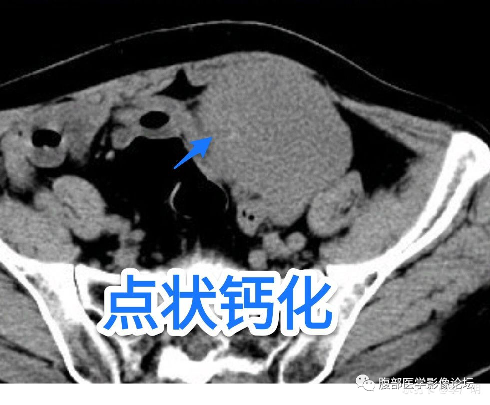 【病例】盆腔精原细胞瘤1例CT影像讨论 【病例】盆腔精原细胞瘤1例CT影像讨论