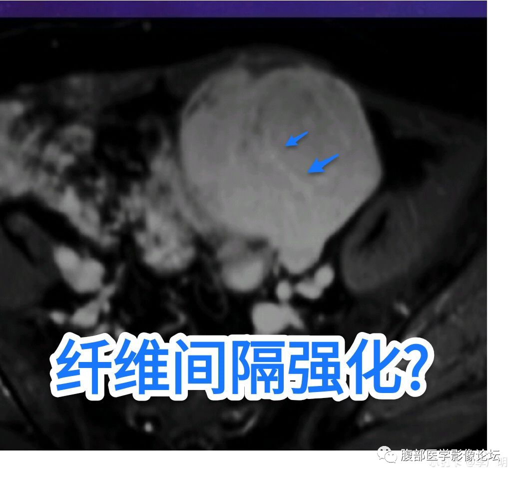 【病例】盆腔精原细胞瘤1例CT影像讨论 【病例】盆腔精原细胞瘤1例CT影像讨论