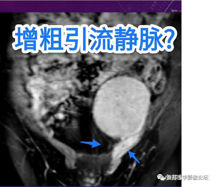 【病例】盆腔精原细胞瘤1例CT影像讨论 【病例】盆腔精原细胞瘤1例CT影像讨论