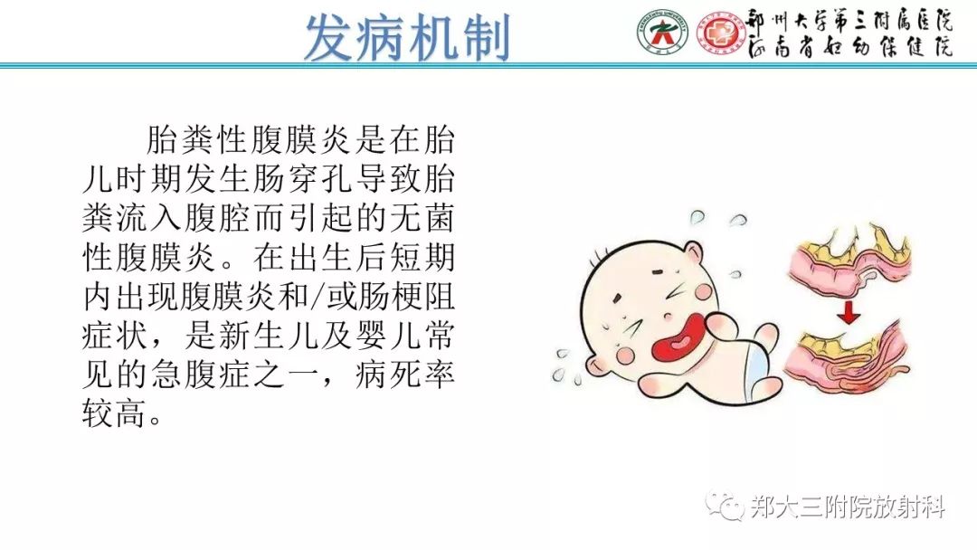 【PPT】胎粪性腹膜炎的影像诊断