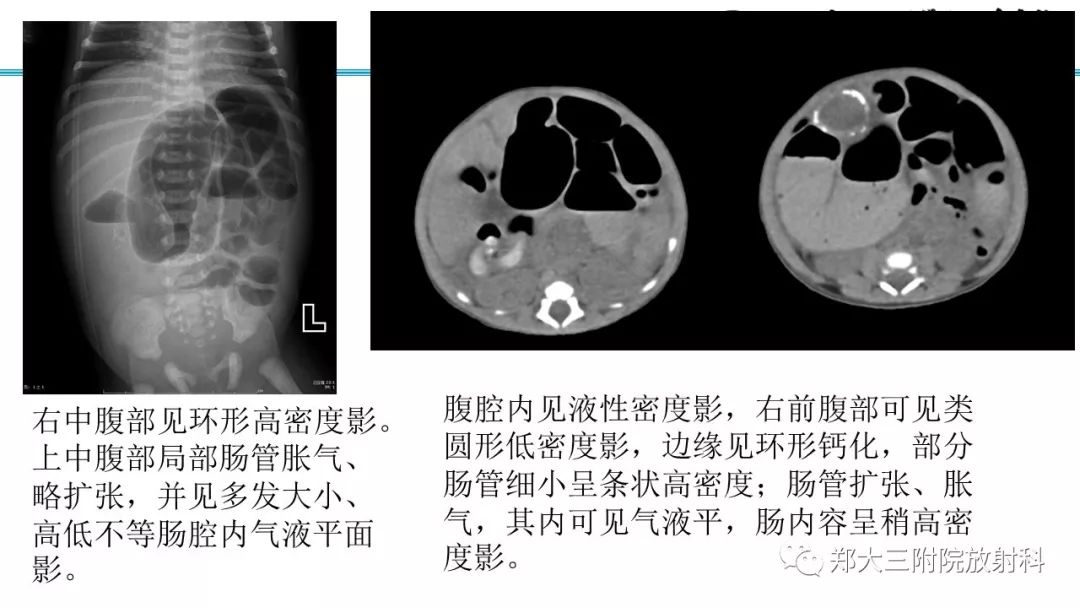 【PPT】胎粪性腹膜炎的影像诊断