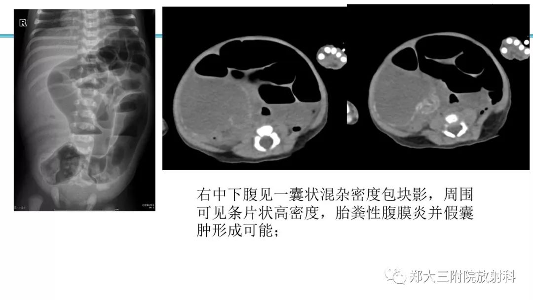 【PPT】胎粪性腹膜炎的影像诊断