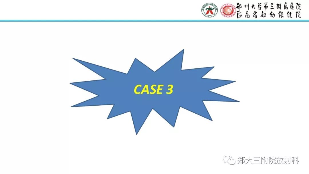 【PPT】胎粪性腹膜炎的影像诊断