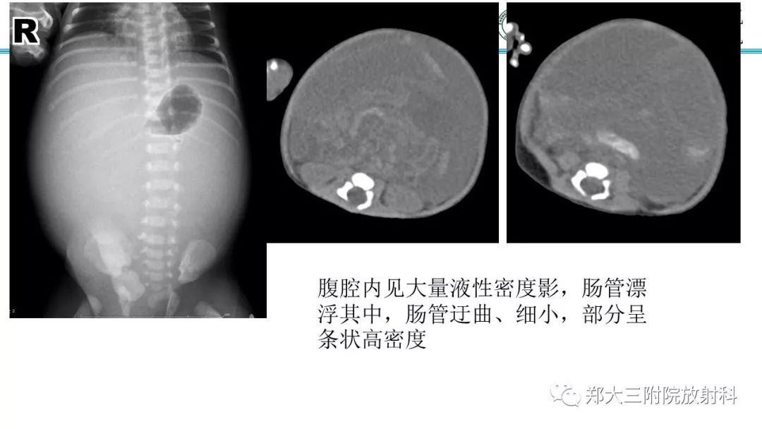 【PPT】胎粪性腹膜炎的影像诊断