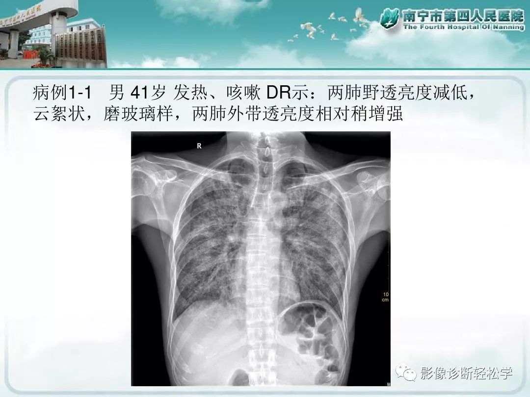【PPT】艾滋病相关性胸部影像学表现