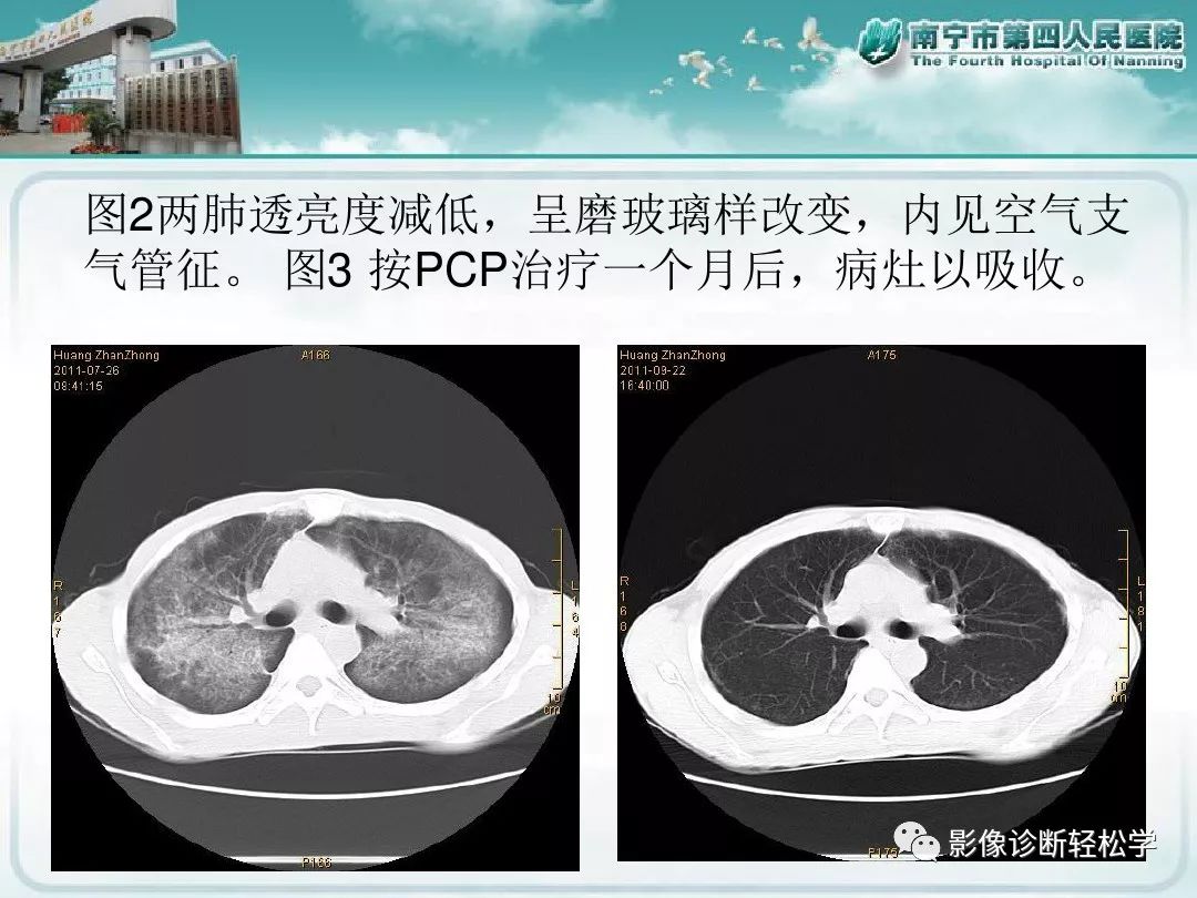【PPT】艾滋病相关性胸部影像学表现