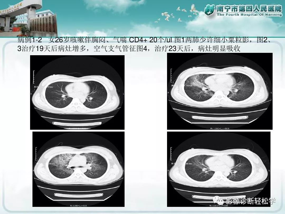 【PPT】艾滋病相关性胸部影像学表现