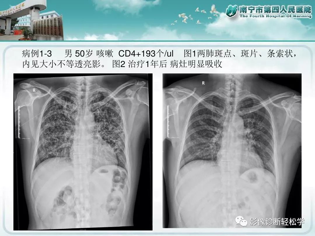 【PPT】艾滋病相关性胸部影像学表现