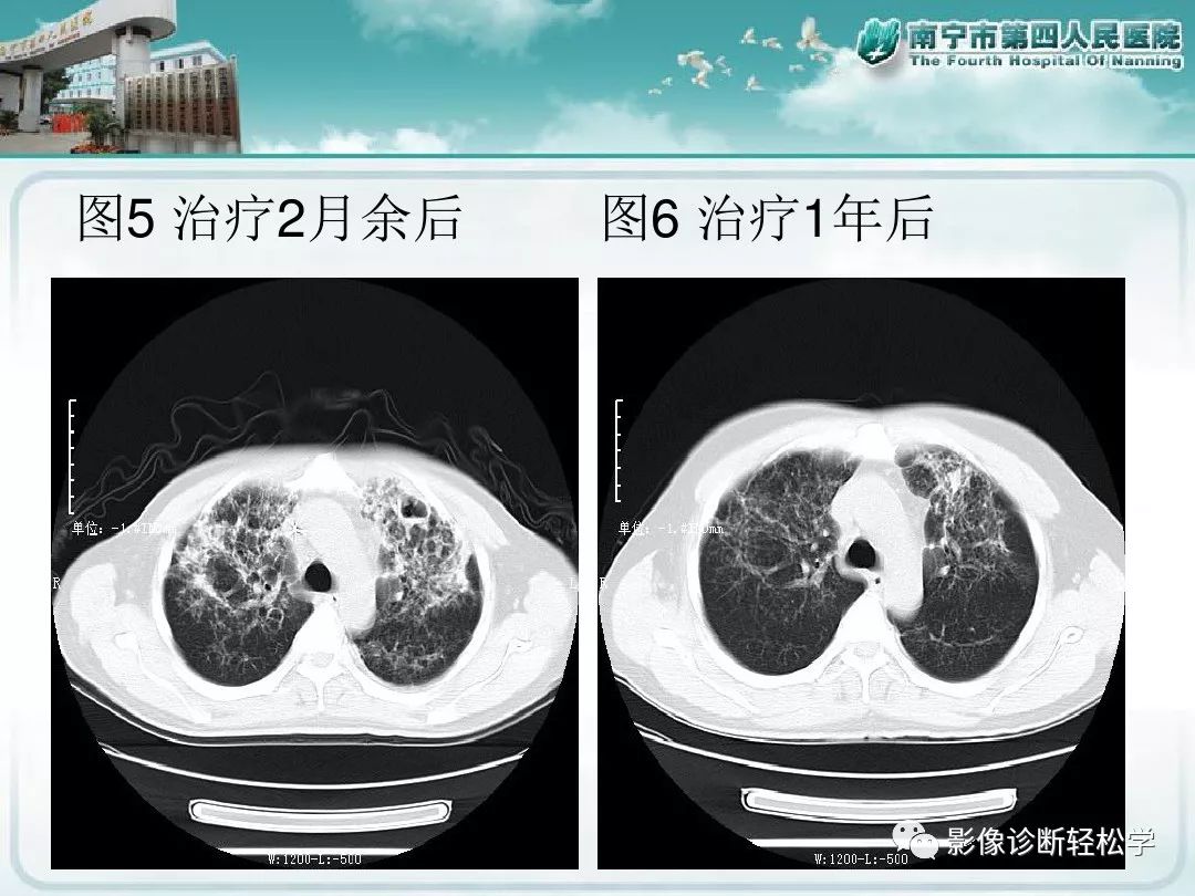【PPT】艾滋病相关性胸部影像学表现