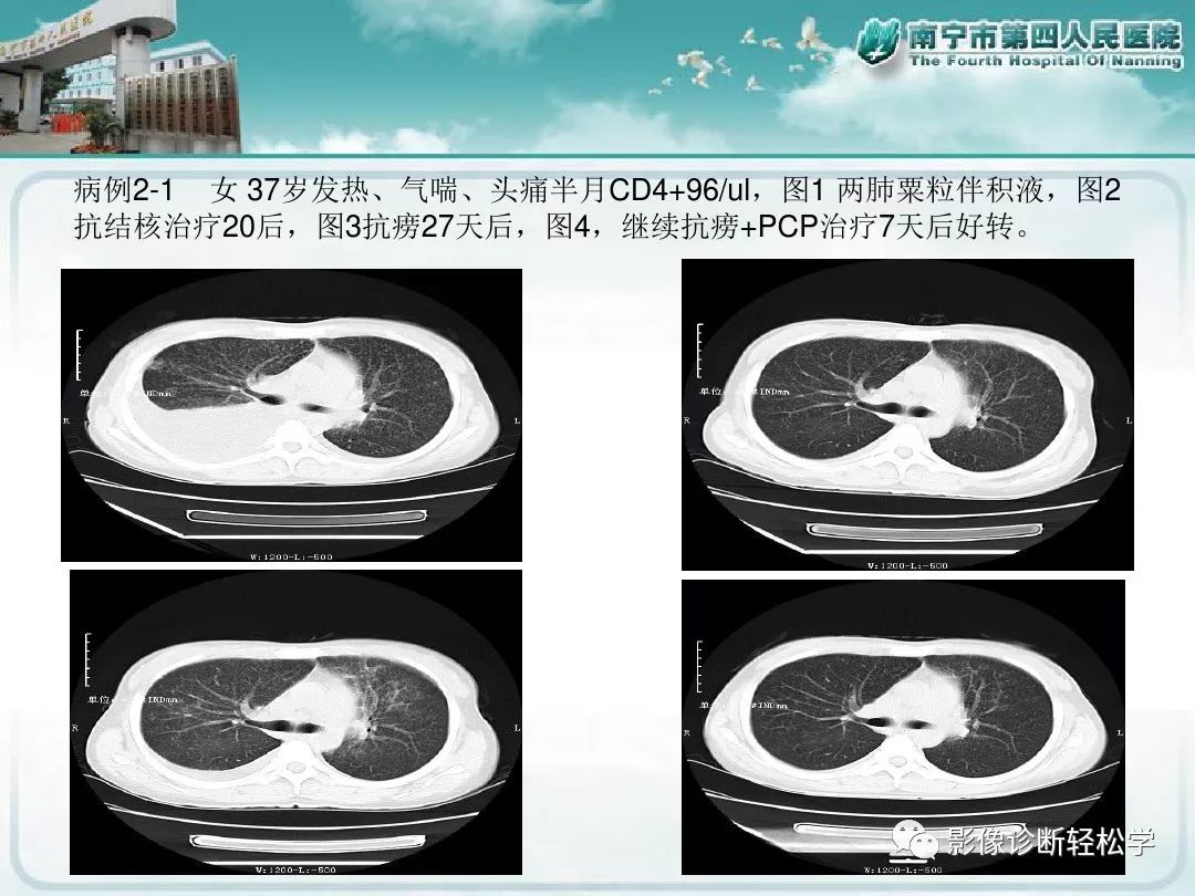 【PPT】艾滋病相关性胸部影像学表现