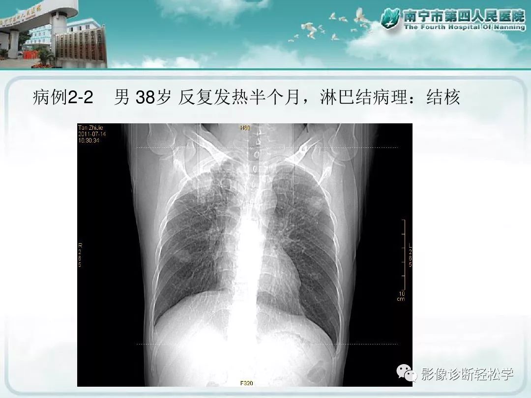 【PPT】艾滋病相关性胸部影像学表现
