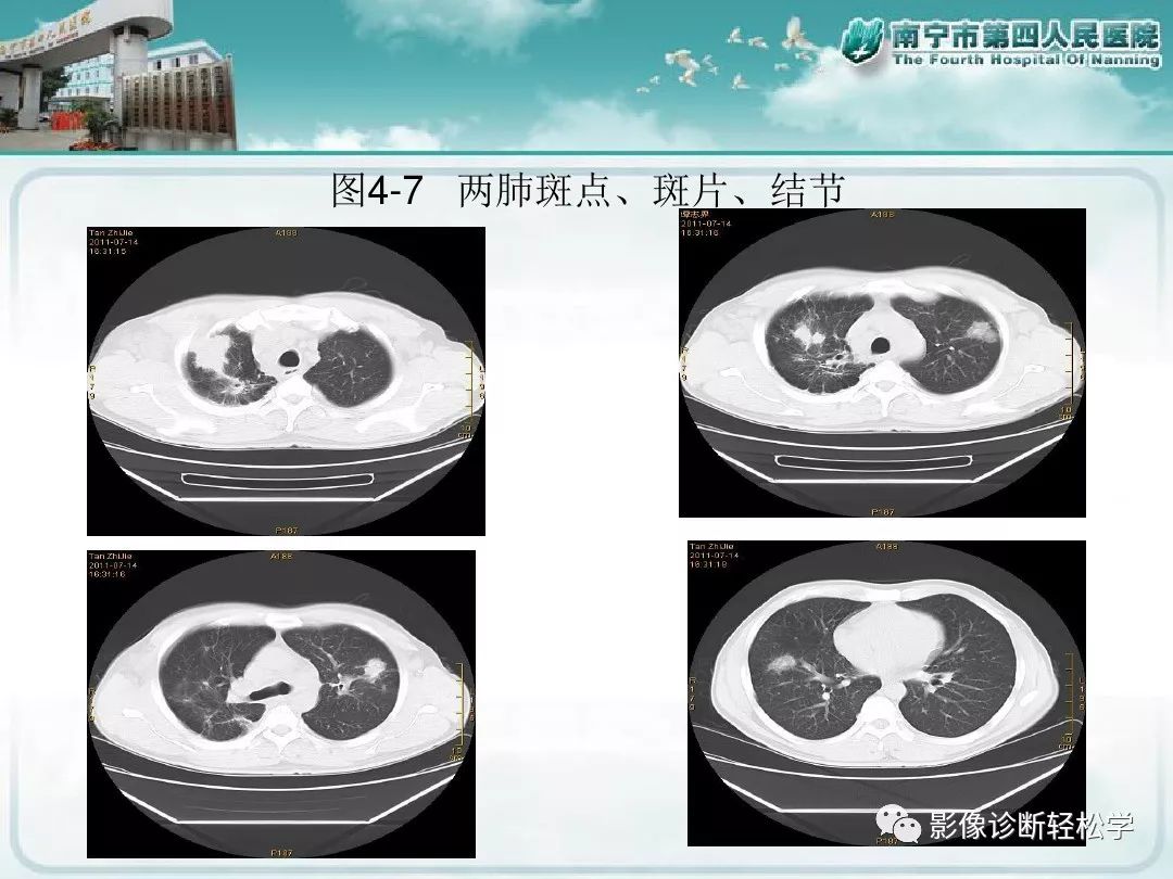 【PPT】艾滋病相关性胸部影像学表现