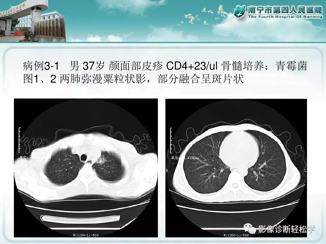【PPT】艾滋病相关性胸部影像学表现