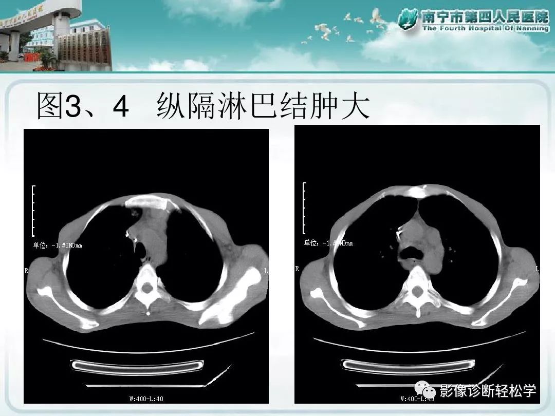 【PPT】艾滋病相关性胸部影像学表现