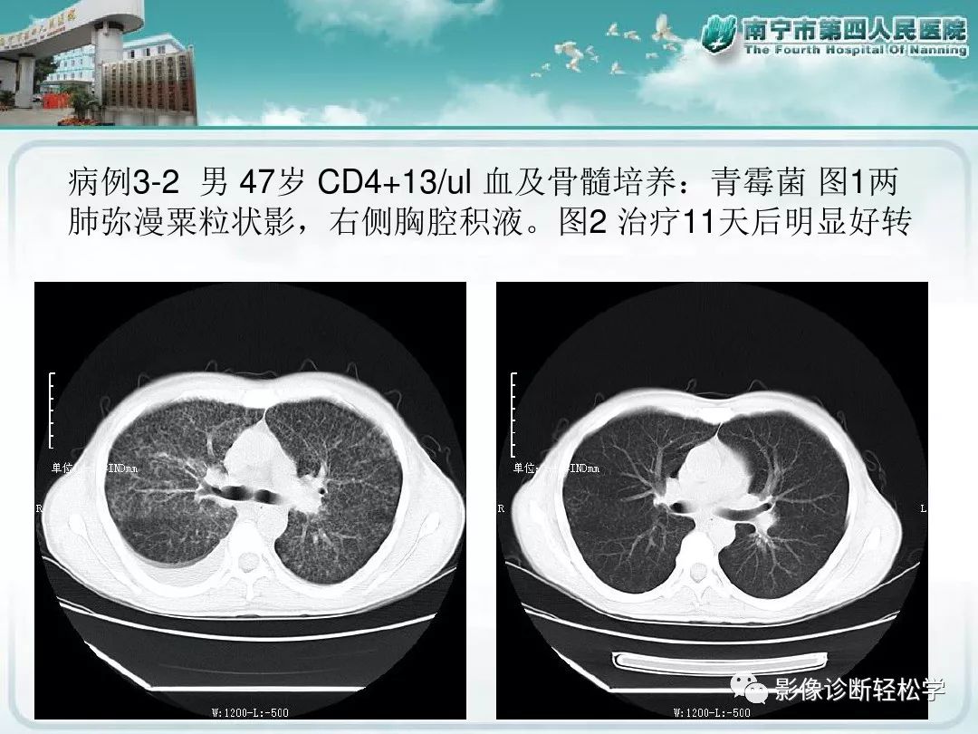 【PPT】艾滋病相关性胸部影像学表现