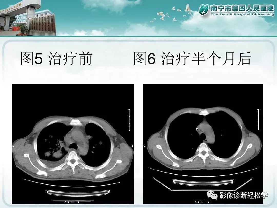 【PPT】艾滋病相关性胸部影像学表现