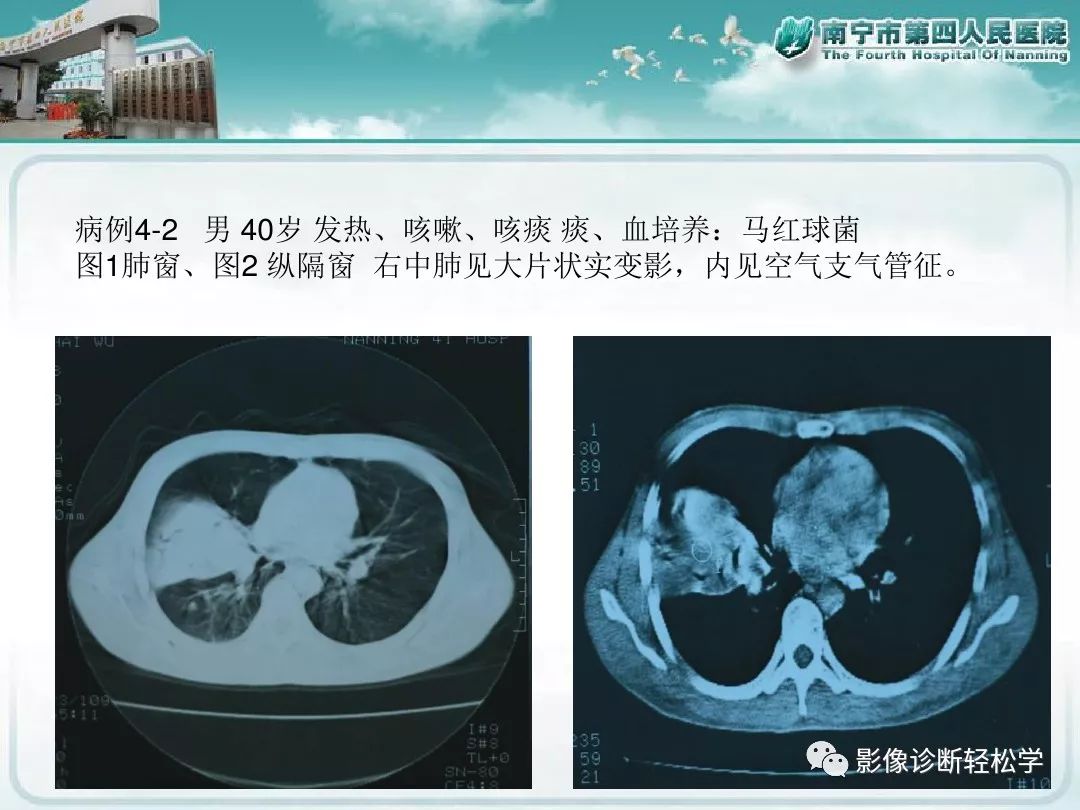 【PPT】艾滋病相关性胸部影像学表现