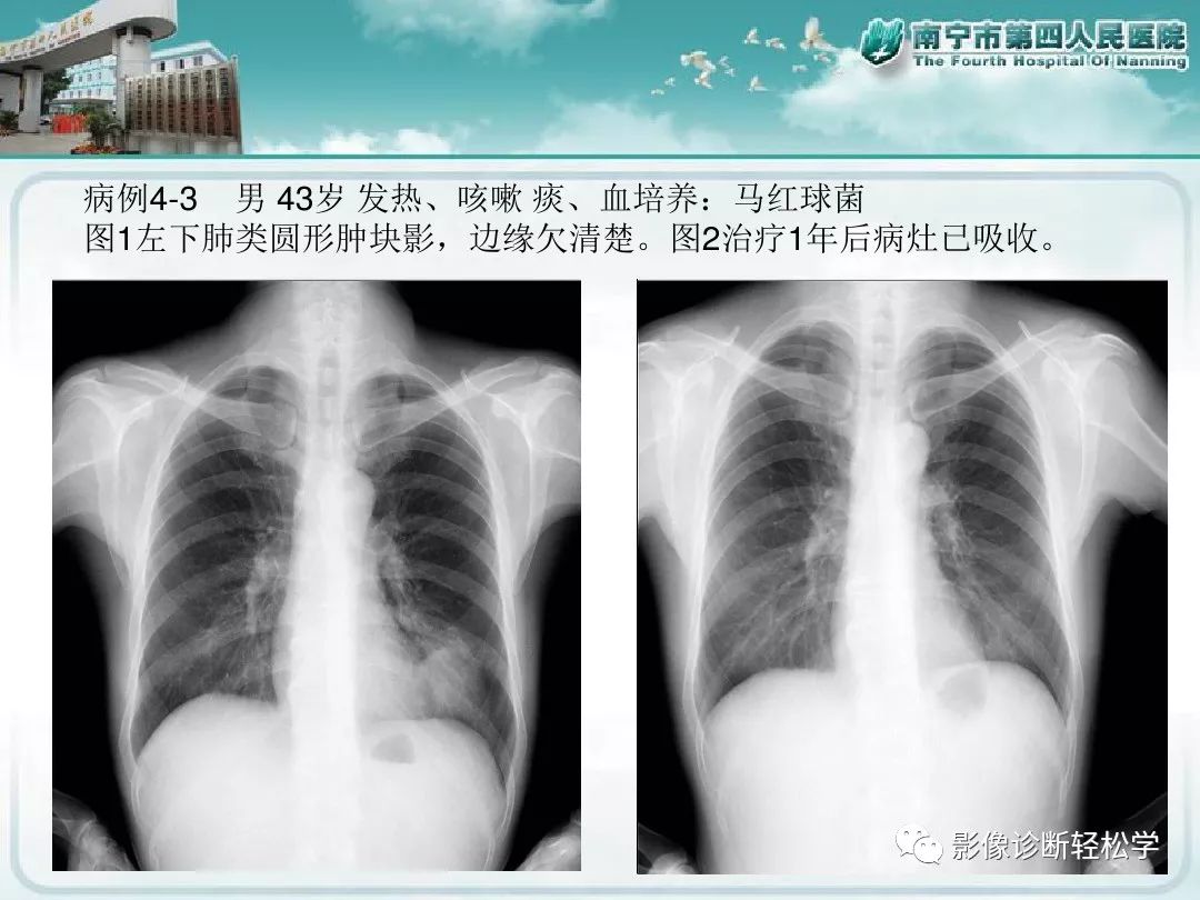 【PPT】艾滋病相关性胸部影像学表现