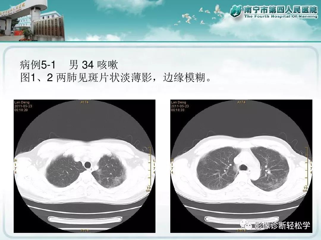 【PPT】艾滋病相关性胸部影像学表现