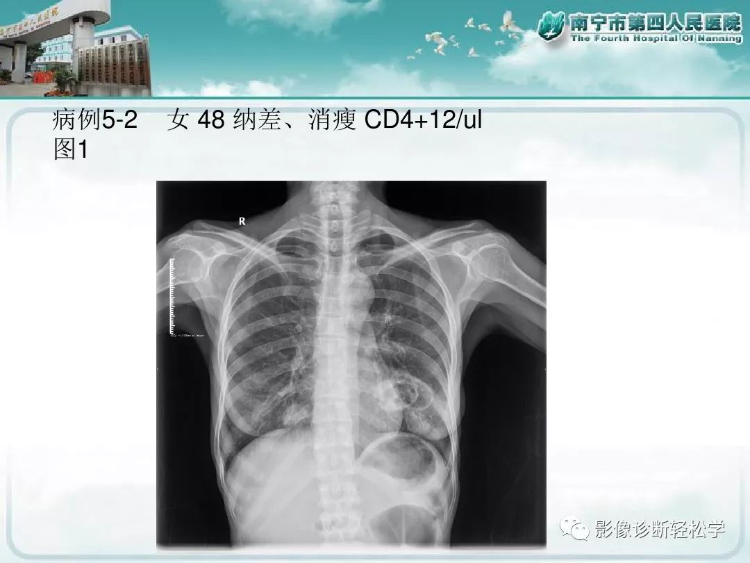 【PPT】艾滋病相关性胸部影像学表现