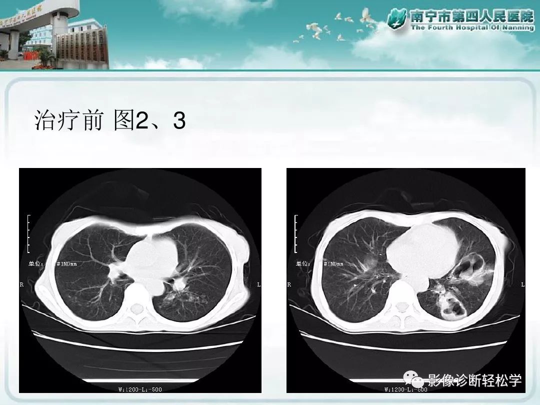 【PPT】艾滋病相关性胸部影像学表现
