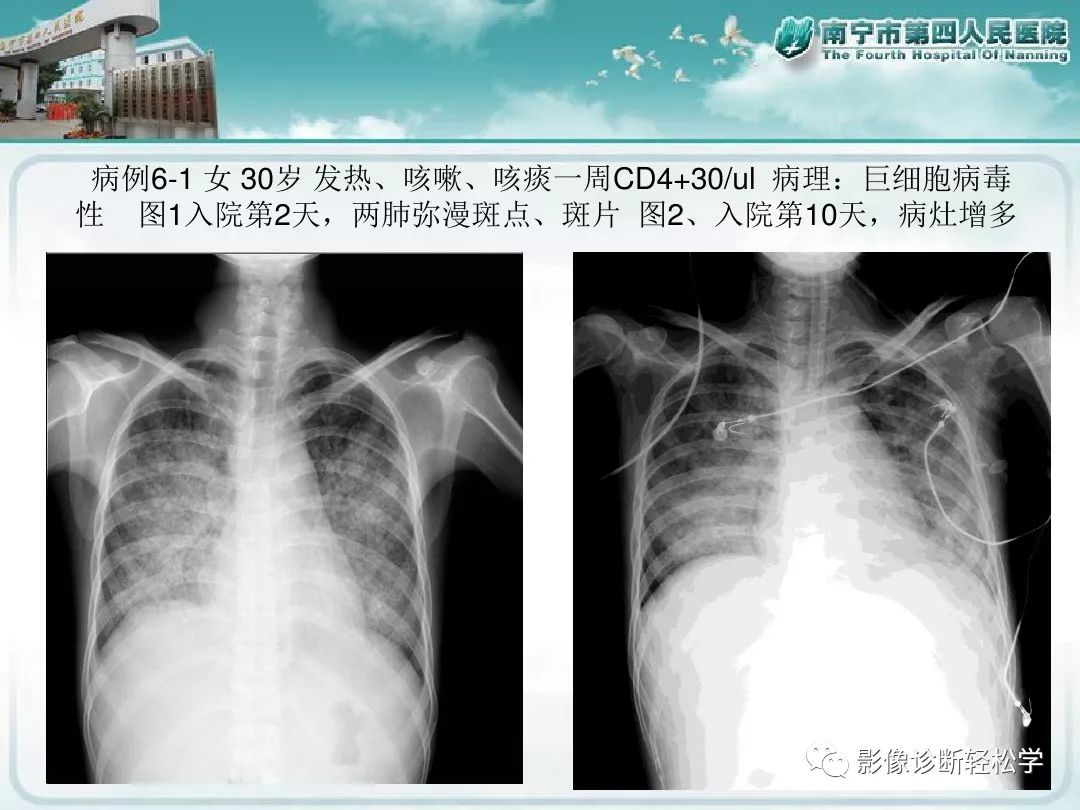 【PPT】艾滋病相关性胸部影像学表现