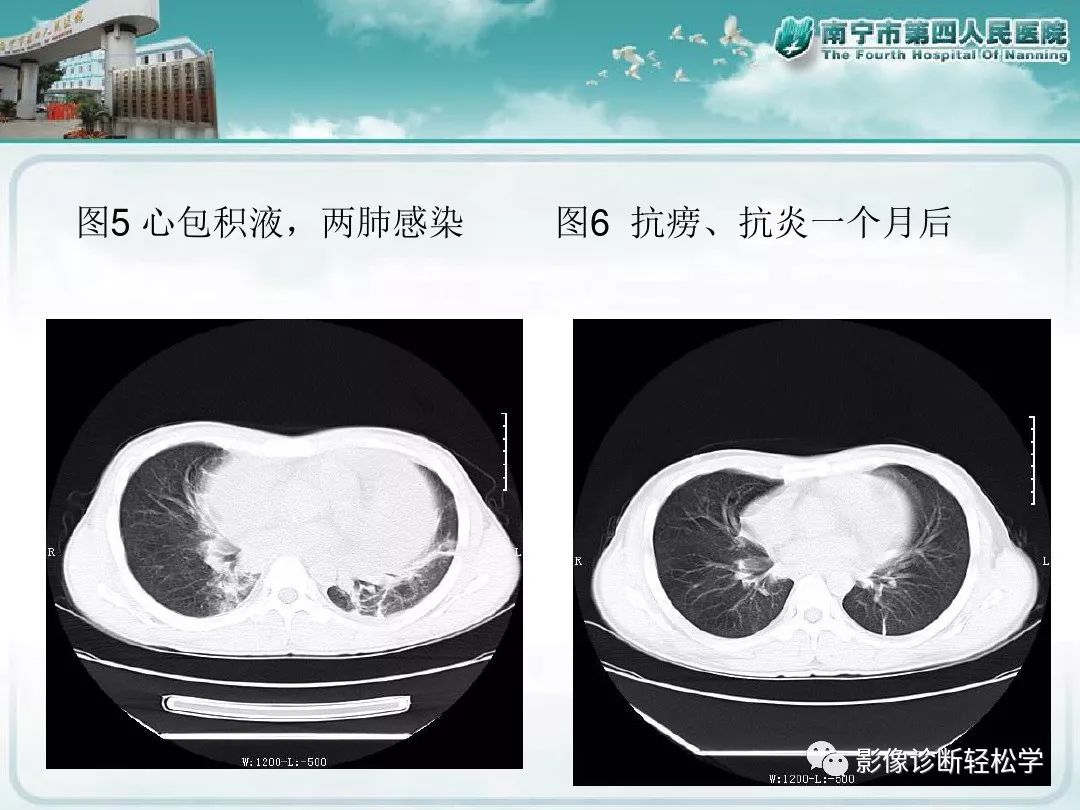 【PPT】艾滋病相关性胸部影像学表现