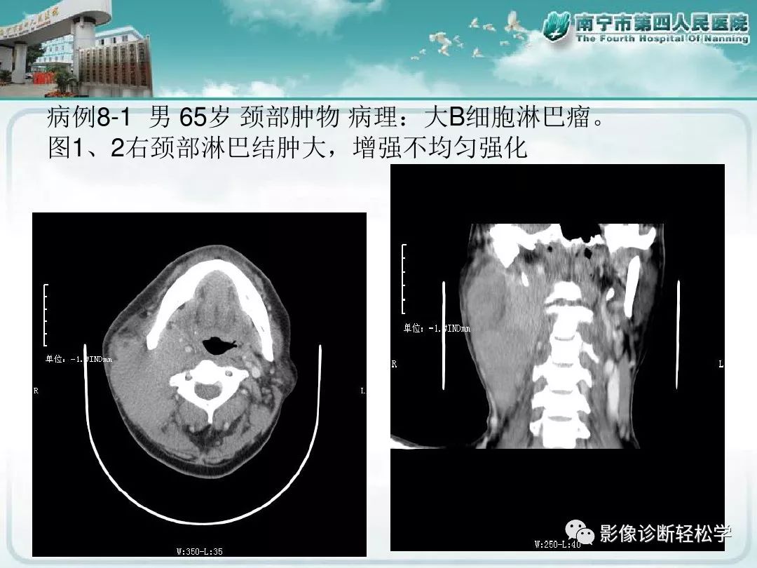 【PPT】艾滋病相关性胸部影像学表现