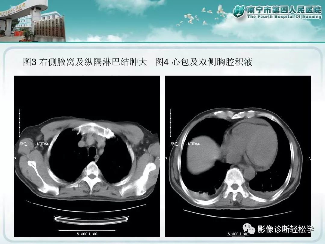 【PPT】艾滋病相关性胸部影像学表现
