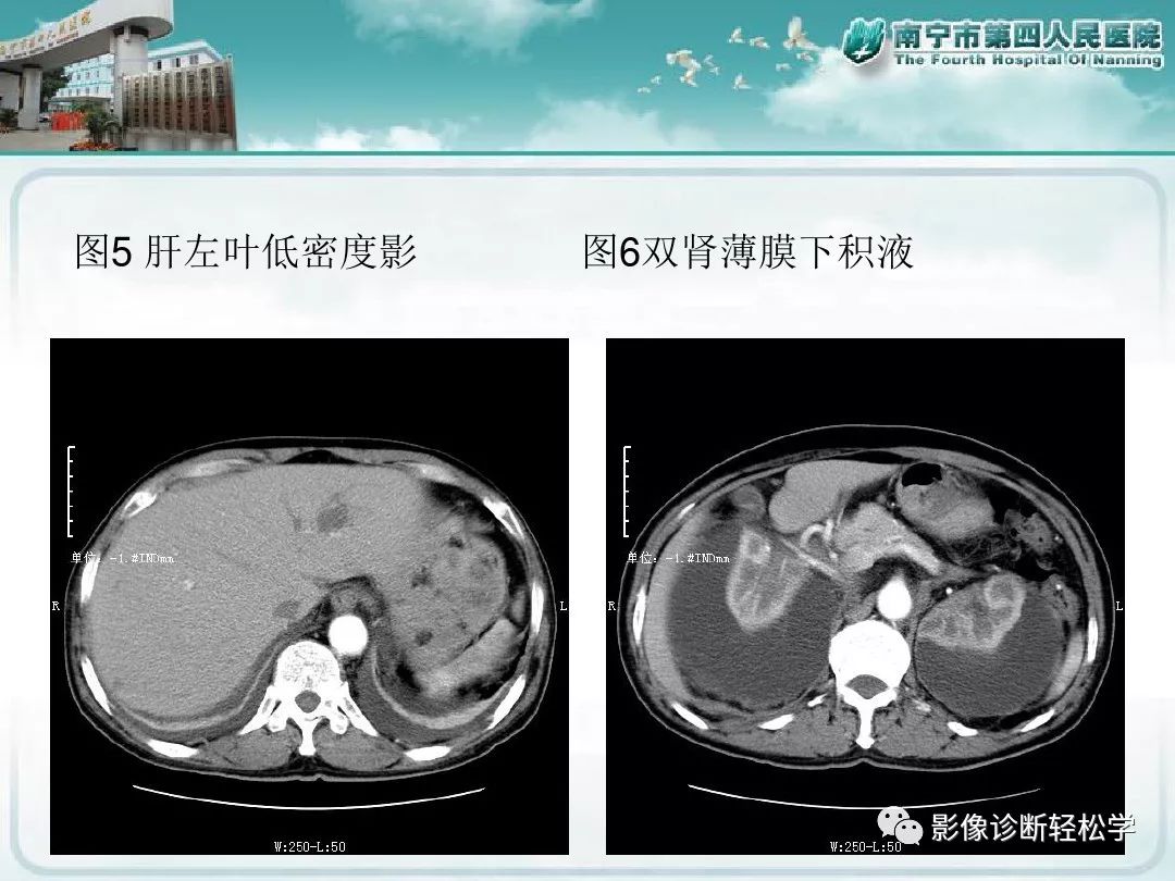 【PPT】艾滋病相关性胸部影像学表现