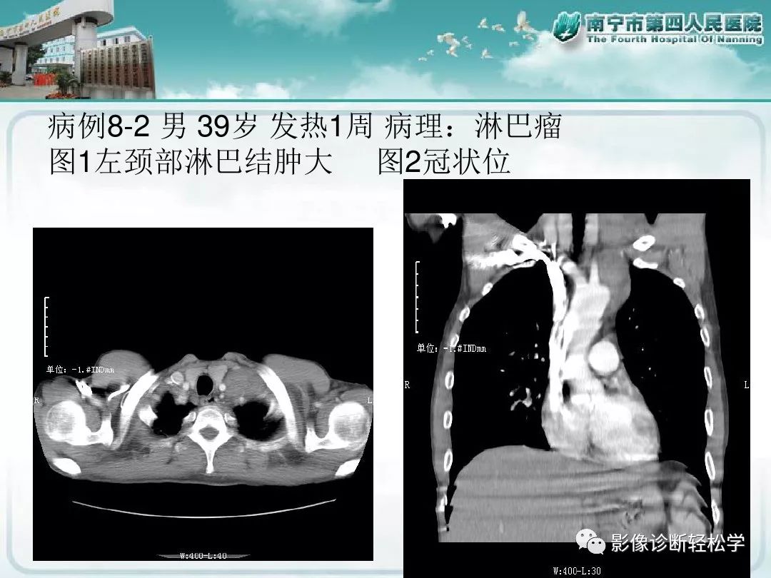 【PPT】艾滋病相关性胸部影像学表现