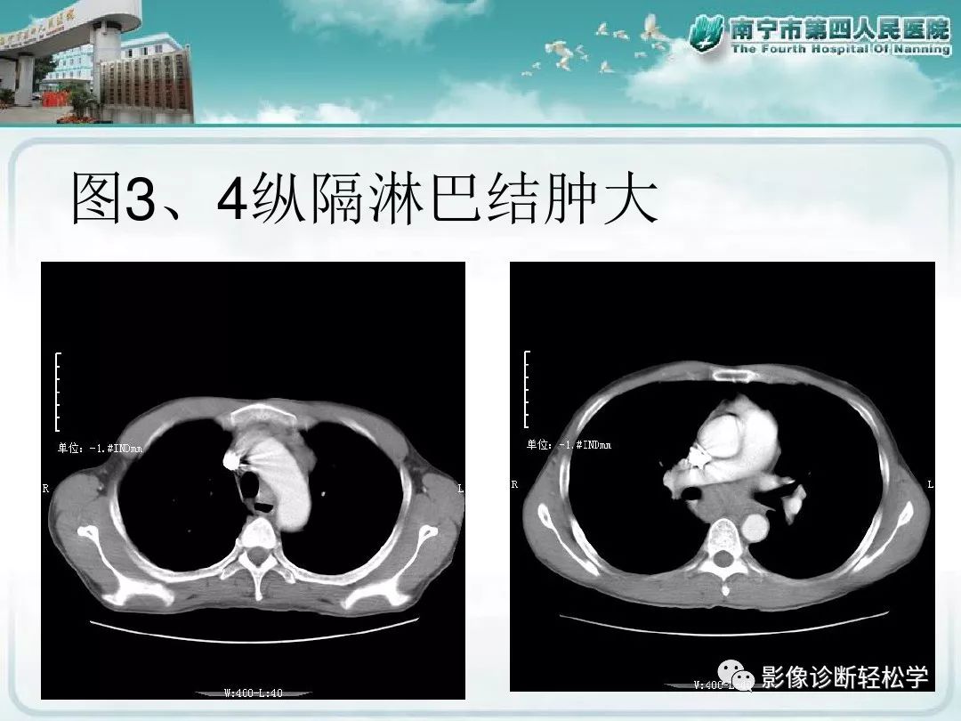 【PPT】艾滋病相关性胸部影像学表现