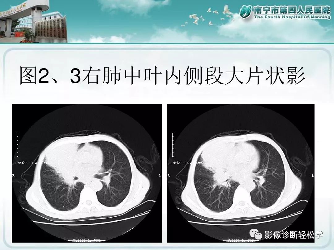【PPT】艾滋病相关性胸部影像学表现