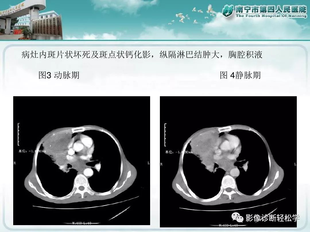 【PPT】艾滋病相关性胸部影像学表现