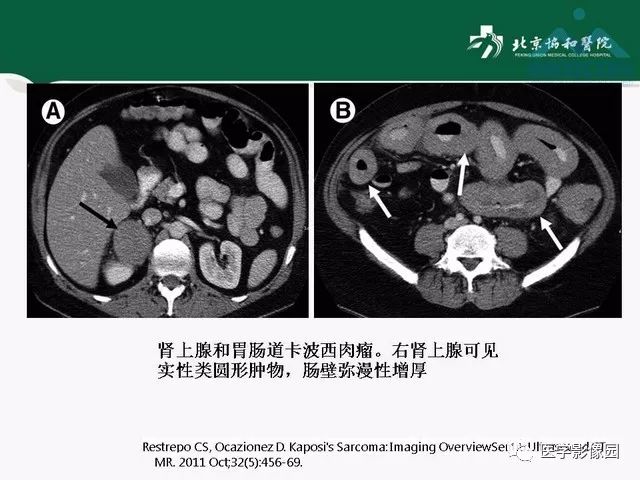 【PPT】艾滋病相关消化道影像学表现